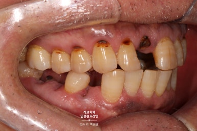 앞니 부러짐? 뽑고 바로 임플란트 + 뼈이식. 앞니 흔들림? 뽑고 1달 기다리고 임플란트 + 뼈이식. 신사역 치과 후기/비용/과정. 관련 이미지 4