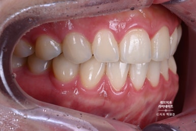 레브네이트 베이직. 치아미백과 치아교정을 한번에! 치아삭제 사진 있음. 신사역 치과 앞니라미네이트 모델/비용/후기. 관련 이미지 4