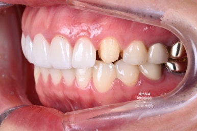 신사역 퍼스널컬러 맞춤 치과. 전담 세라미스트가 앞니 크라운과 라미네이트를 만들어 드립니다. 관련 이미지 3