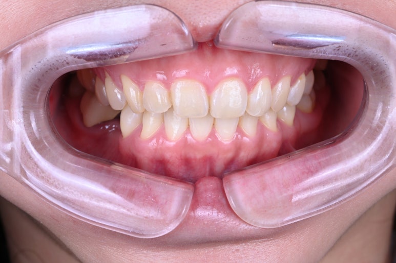 신사역 라미네이트. 결혼식 전 앞니 고민, 얇은 세라믹 레브네이트로 해결! 관련 이미지 2