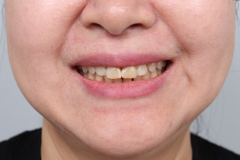 레브네이트 엑스퍼트 - 앞니 무삭제 라미네이트. 40대 벌어진 앞니에 변색된 레진은 이제 그만! 압구정 치과 추천 전후/비용. 관련 이미지 12