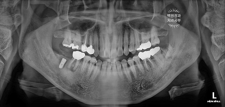 신경치료한 치아 부러짐! 뼈이식 하면서 임플란트 수술하는 과정/기간/비용. 관련 이미지 10