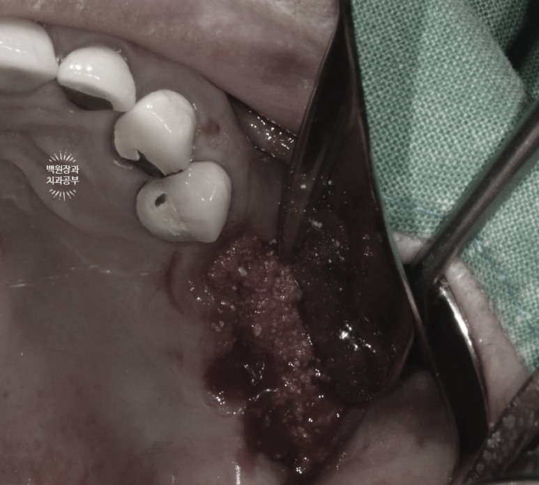 임플란트에서 고름이 나와요. 임플란트 주위염 그리고 재수술을 위한 준비. 치료과정/치료기간/비용/후기. 관련 이미지 18