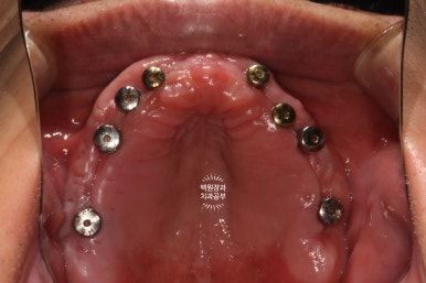 만성치주염으로 인해 아주 좁아진 잇몸뼈에 광범위한 뼈이식 + 전체임플란트. 신사 레브치과. 관련 이미지 43