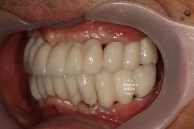 불편한 틀니를 아직도 쓰시나요? 전체 임플란트 치료비용/치료기간/치료과정. 관련 이미지 26