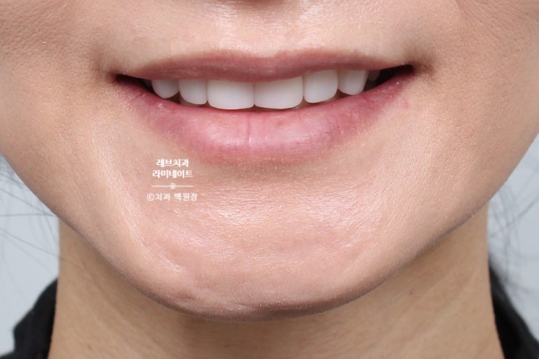 아래앞니 라미네이트도 무삭제로 가능한가요? 레브네이트 베이직 가격/비용/후기/추천. 관련 이미지 6