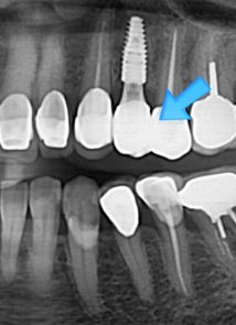 치과의사가 추천하는 가장 좋은 임플란트 회사: 세계 1위 스트라우만 vs 국내 1위 오스템임플란트 비교와 설명. 관련 이미지 12