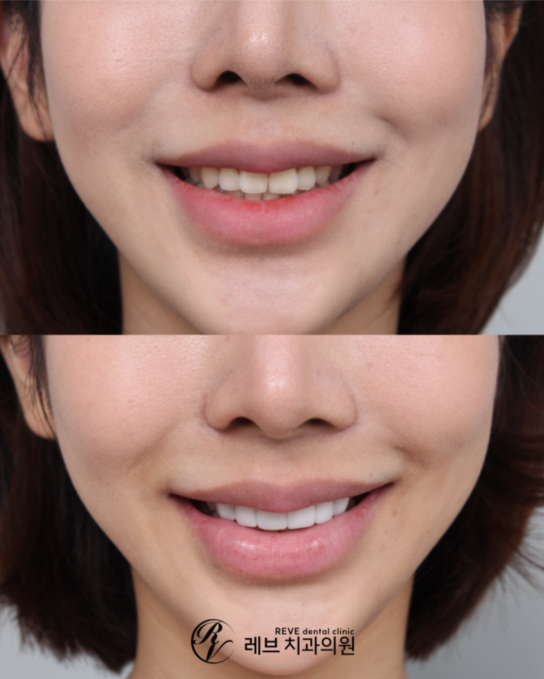 What About Laminates at Sinsa Station? Rev Dental Clinic’s Revnate. image 19