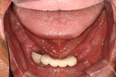 잇몸 염증 고름이 심했던 부위 - 만성치주염 진단하고 임플란트로 깔끔하게 치료! 신사역 치과 관련 이미지 20