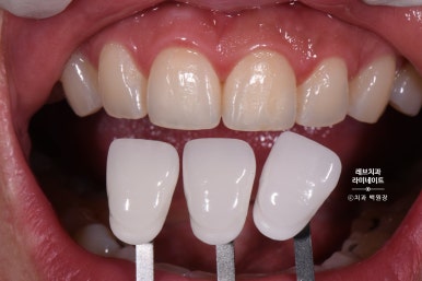 레브네이트 베이직. 치아미백과 치아교정을 한번에! 치아삭제 사진 있음. 신사역 치과 앞니라미네이트 모델/비용/후기. 관련 이미지 8