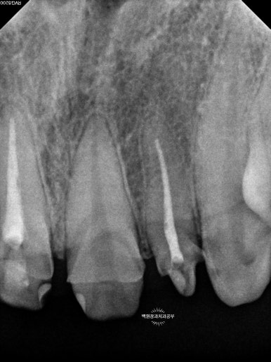 앞니에 잇몸염증과 충치가 심해요. 앞니 지르코니아 크라운 성공 후기. 치료과정/치료기간/비용/전후비교. 관련 이미지 12
