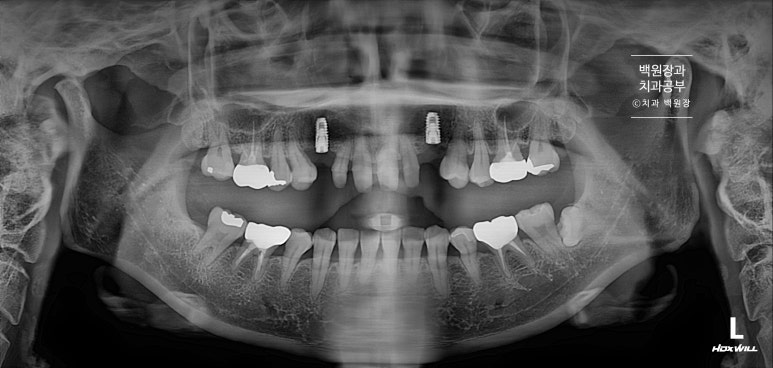 크라운 앞니 충치로 냄새가 나요 - 최소한의 임플란트와 씌우는 치료. 치료과정/기간/비용. 관련 이미지 6