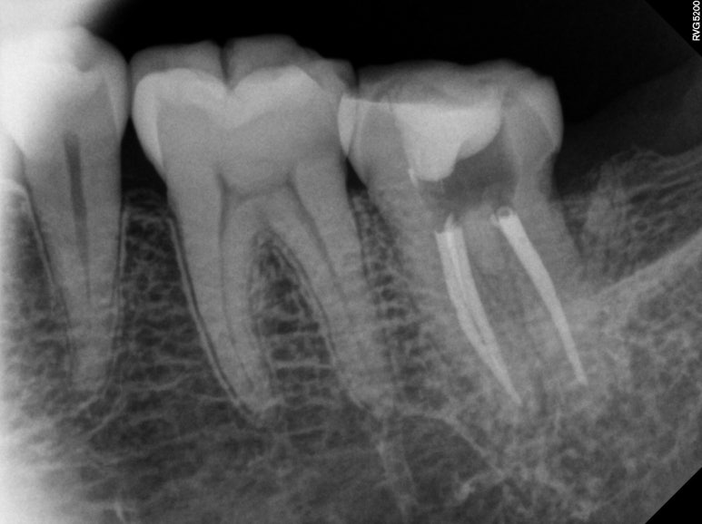 치아크랙 (금간 치아)의 찌릿한 통증 - 발치하지 않고 살려보기. 원인/진단/치료과정/비용/기간. 보존과전문의 치과. 관련 이미지 10