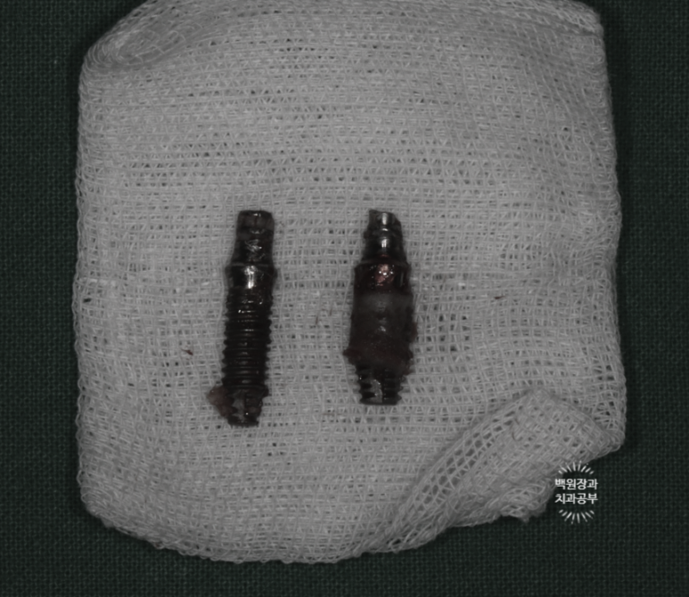 임플란트에서 고름이 나와요. 임플란트 주위염 그리고 재수술을 위한 준비. 치료과정/치료기간/비용/후기. 관련 이미지 14