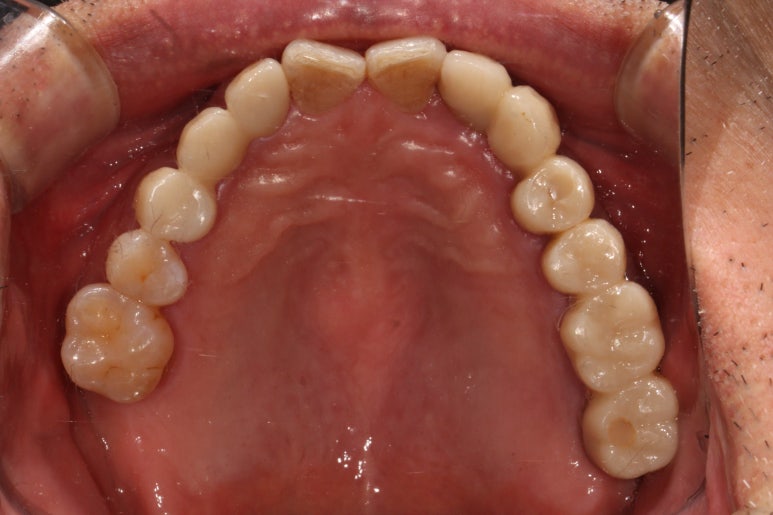 치주염 앞니 잇몸 염증으로 흔들릴 때 - 앞니 브릿지와 임플란트 장단점, 비용. 치료과정과 결과를 눈으로 보여주는 치과. 관련 이미지 16