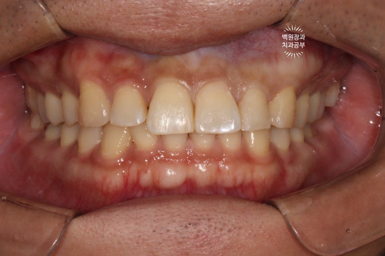 교정 유지장치 근처 앞니 옆면 충치 및 착색 간단히 3M 레진으로 치료. 치료과정/비용/후기. 과잉진료 없는 치과. 관련 이미지 9