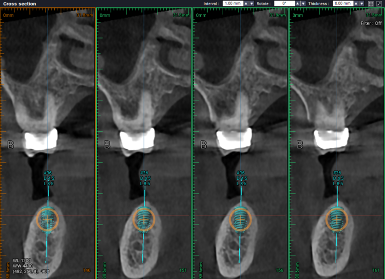 어금니 임플란트 주변 잇몸이식수술 - 저는 해야한다고 생각합니다. (feat. 대한치과의사협회 논문 + 치주과전문) 관련 이미지 14
