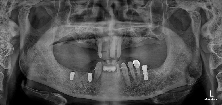 큰 어금니를 잃을 정도의 풍치를 앓으셨다면, 조속한 어금니 임플란트는 필수입니다. 관련 이미지 10