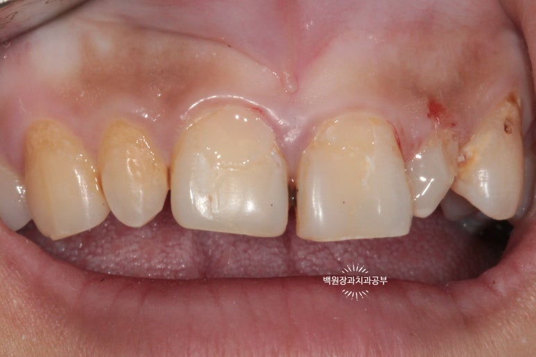 앞니에 잇몸염증과 충치가 심해요. 앞니 지르코니아 크라운 성공 후기. 치료과정/치료기간/비용/전후비교. 관련 이미지 10