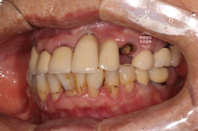 스트라우만 임플란트로 이뽑고 바로심는치과 - 믿고 사용하는 세계 1위 스위스 임플란트 회사. 관련 이미지 37