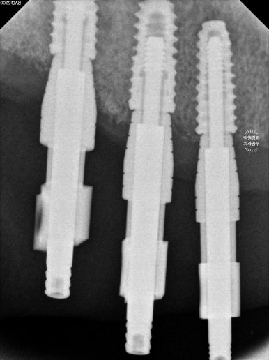 만성치주염으로 인해 아주 좁아진 잇몸뼈에 광범위한 뼈이식 + 전체임플란트. 신사 레브치과. 관련 이미지 46