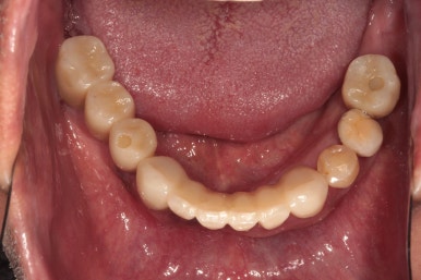 큰 어금니를 잃을 정도의 풍치를 앓으셨다면, 조속한 어금니 임플란트는 필수입니다. 관련 이미지 21