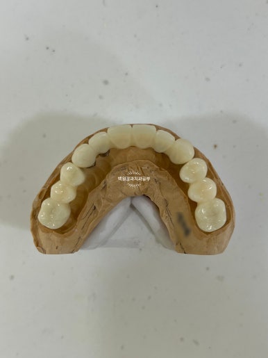 오스템임플란트 네비게이션 전체 임플란트 치료일기. 치료과정/치료기간/비용/솔직후기. 관련 이미지 21