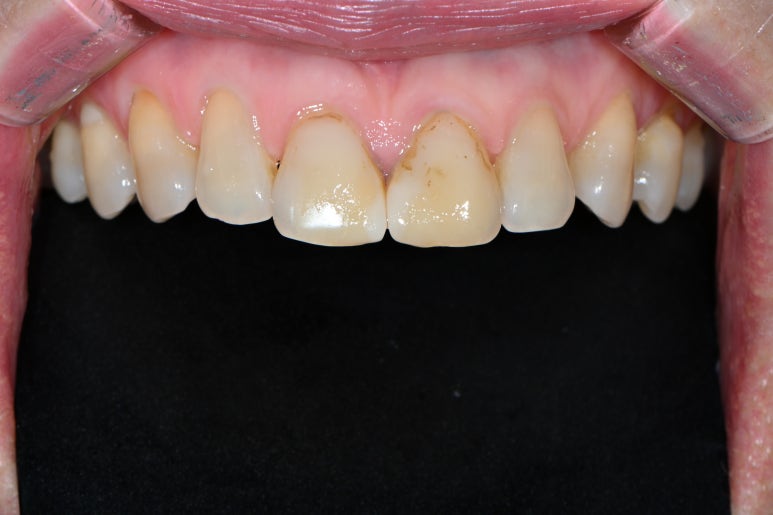 레브네이트 엑스퍼트 - 앞니 무삭제 라미네이트. 40대 벌어진 앞니에 변색된 레진은 이제 그만! 압구정 치과 추천 전후/비용. 관련 이미지 5