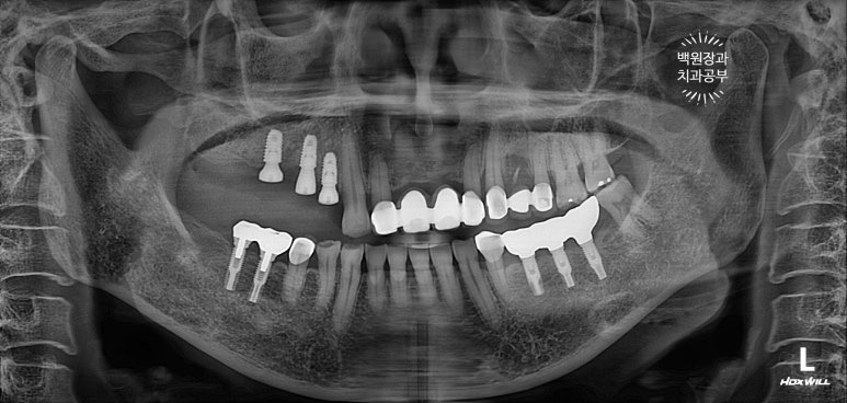60대 임플란트 주변에서 고름이 나와요. 실패한 임플란트 제거 후 재수술. 덴티움 뼈이식재를 사용한 치조골 이식술. 관련 이미지 14