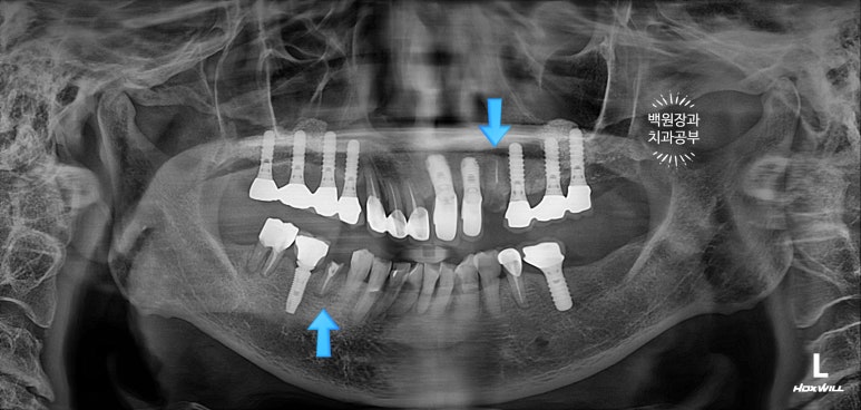 스트라우만 임플란트로 이뽑고 바로심는치과 - 믿고 사용하는 세계 1위 스위스 임플란트 회사. 관련 이미지 3