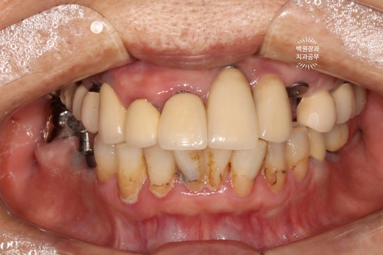 스트라우만 임플란트로 이뽑고 바로심는치과 - 믿고 사용하는 세계 1위 스위스 임플란트 회사. 관련 이미지 16