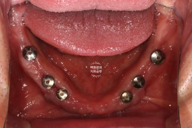 만성치주염으로 인해 아주 좁아진 잇몸뼈에 광범위한 뼈이식 + 전체임플란트. 신사 레브치과. 관련 이미지 44