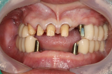 임플란트장인의 마음으로 8개월간 전체임플란트 완성. 치주과 전문의. 관련 이미지 25