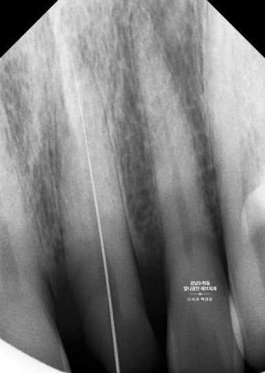 강남논현동치과 60대 치아부러짐 - 신경치료하고 기둥심고 앞니 크라운 잘하는곳! 가격/과정/후기/부작용. 관련 이미지 5