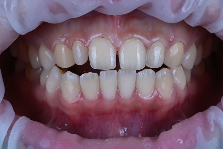 왜소치 라미네이트. 열심히 교정치료 받은 나를 위한 선물. 비용/과정/후기. 관련 이미지 8