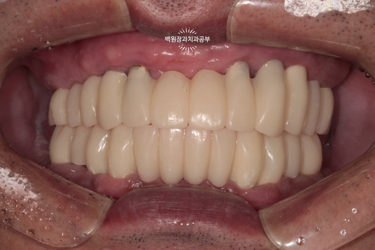 오스템임플란트 네비게이션 전체 임플란트 치료일기. 치료과정/치료기간/비용/솔직후기. 관련 이미지 34