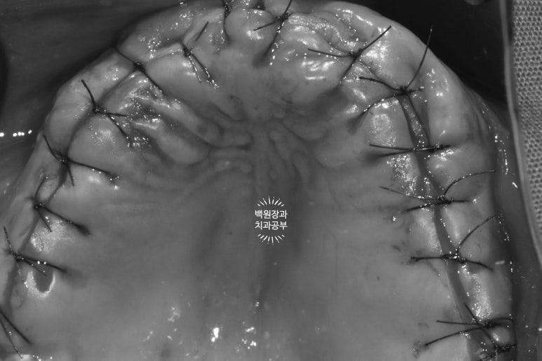 만성치주염으로 인해 아주 좁아진 잇몸뼈에 광범위한 뼈이식 + 전체임플란트. 신사 레브치과. 관련 이미지 29