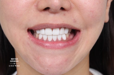 레브네이트 베이직. 치아미백과 치아교정을 한번에! 치아삭제 사진 있음. 신사역 치과 앞니라미네이트 모델/비용/후기. 관련 이미지 25