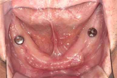 오스템임플란트 네비게이션 전체 임플란트 치료일기. 치료과정/치료기간/비용/솔직후기. 관련 이미지 9