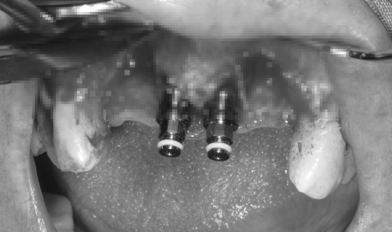 앞니가 풍치로 흔들거려요. 심한 치주염인데 임플란트 가능할까요? 치료과정/치료기간/비용/성공후기. 신금호역 치과 추천. 관련 이미지 18