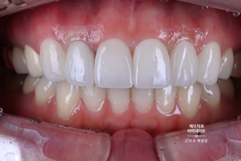 신사역 퍼스널컬러 맞춤 치과. 전담 세라미스트가 앞니 크라운과 라미네이트를 만들어 드립니다. 관련 이미지 9