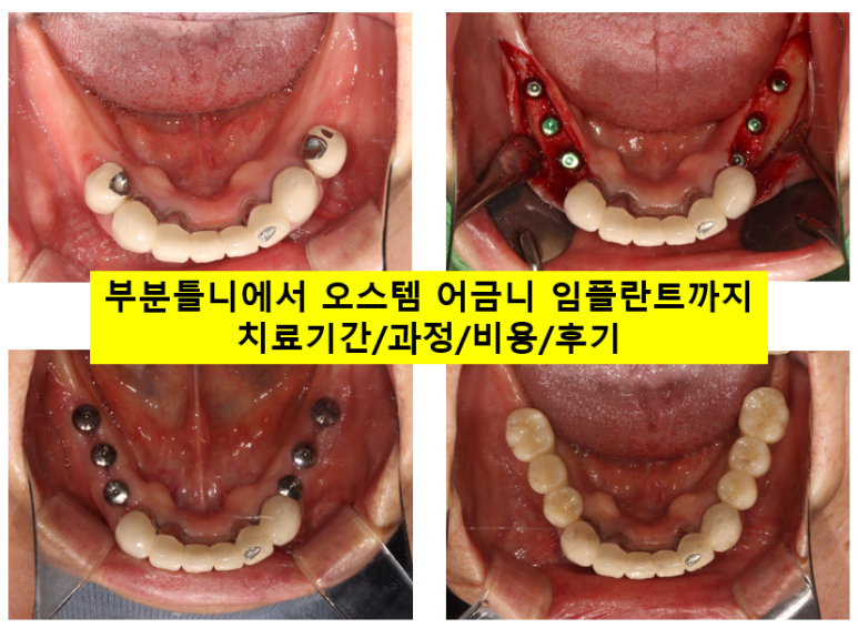 부분틀니를 오래써서 어금니가 아플 때, 아래턱 양쪽 어금니 임플란트 잘하는 강남임플란트치과 관련 이미지 1