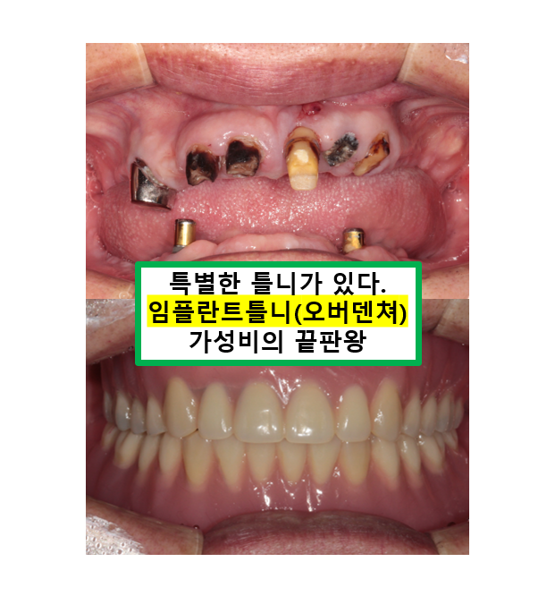 임플란트틀니 - 오버덴쳐. 오스템BA임플란트 이용한 최고의 가성비 치료. 치료과정/치료기간/비용/후기. 관련 이미지 1