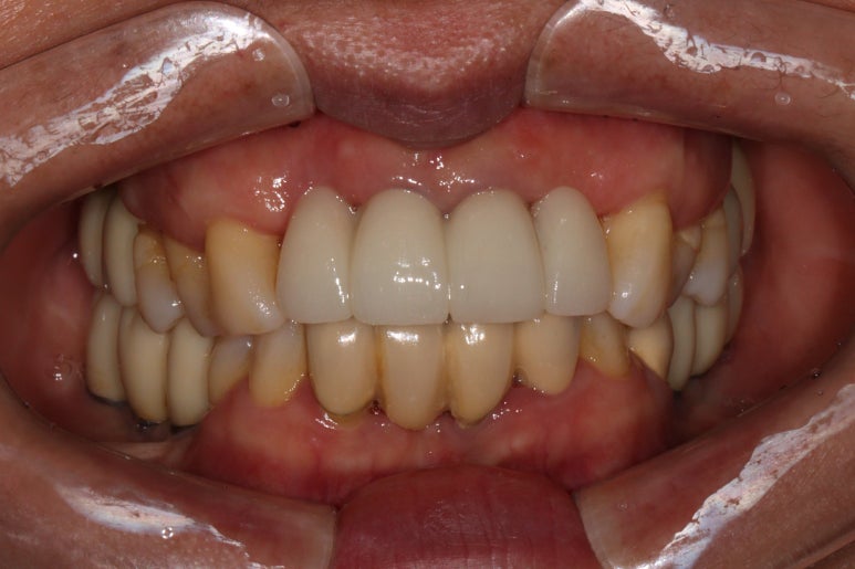 앞니가 풍치로 흔들거려요. 심한 치주염인데 임플란트 가능할까요? 치료과정/치료기간/비용/성공후기. 신금호역 치과 추천. 관련 이미지 30