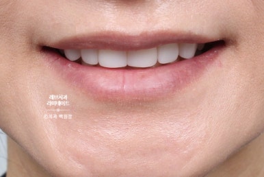 아래앞니 라미네이트도 무삭제로 가능한가요? 레브네이트 베이직 가격/비용/후기/추천. 관련 이미지 16