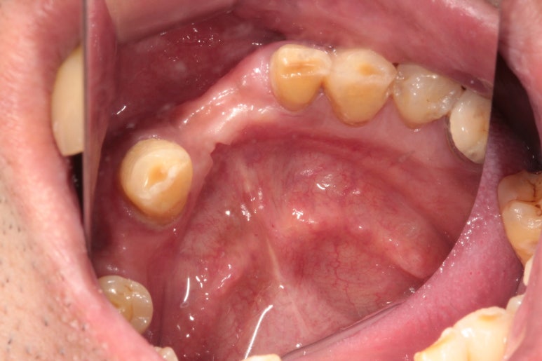 큰 어금니를 잃을 정도의 풍치를 앓으셨다면, 조속한 어금니 임플란트는 필수입니다. 관련 이미지 7