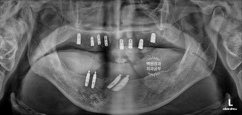 불편한 틀니를 아직도 쓰시나요? 전체 임플란트 치료비용/치료기간/치료과정. 관련 이미지 11