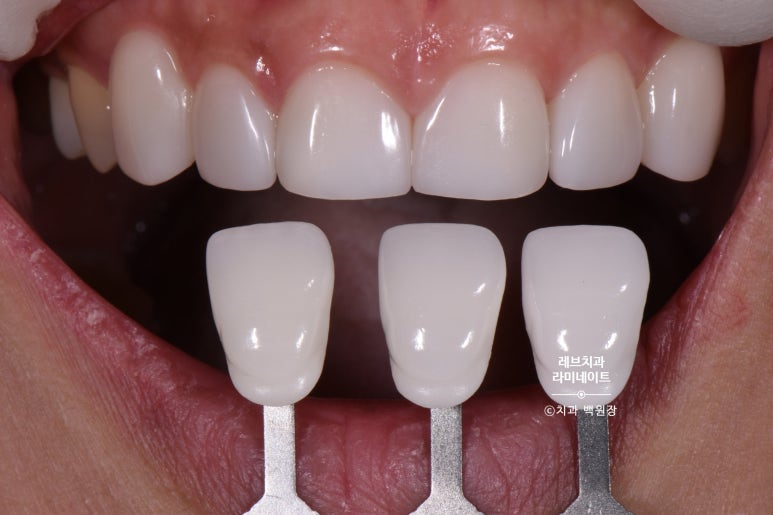 아래앞니 라미네이트도 무삭제로 가능한가요? 레브네이트 베이직 가격/비용/후기/추천. 관련 이미지 5