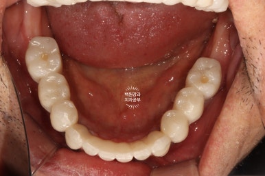 불편한 틀니를 아직도 쓰시나요? 전체 임플란트 치료비용/치료기간/치료과정. 관련 이미지 28