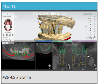 아래 어금니 임플란트 6개면 틀니를 안써도 됩니다.  치주염 전문 착한치과. 치료기간/임시치아과정/후기/비용. 관련 이미지 10